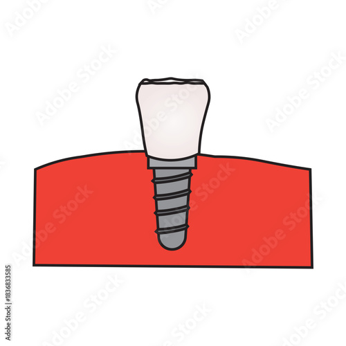 Incisor Dental Implant
