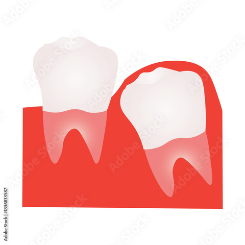 Impacted Wisdom Tooth and Dental Problem Illustration