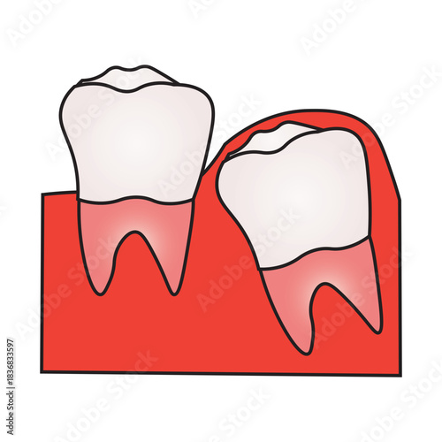 Impacted Wisdom Tooth and Dental Problem Illustration