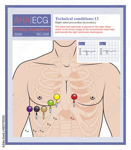 The right chest lead is to place a chest lead electrode on the right chest, which is the mirror image of the left chest lead, and is used to explore the right ventricular electrocardiogram.
