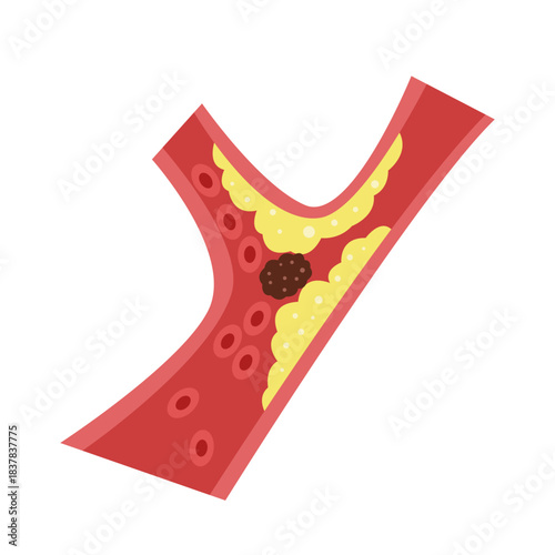 Cholesterol Buildup in Blood Vessel concept