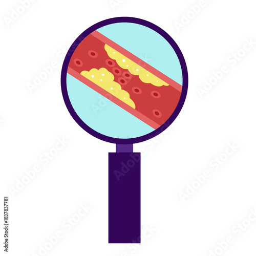 Cholesterol Buildup in Blood Vessel concept