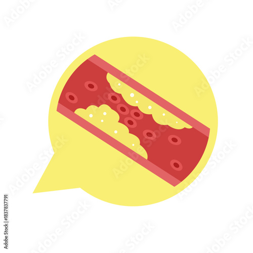 Cholesterol Buildup in Blood Vessel concept