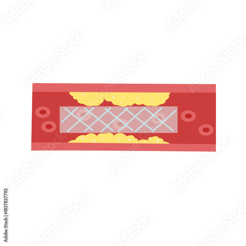Cholesterol Buildup in Blood Vessel concept