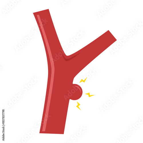 Cholesterol Buildup in Blood Vessel concept