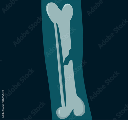 Illustration of Broken Bone X-Ray