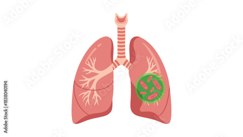 Illustration of Human Lungs Showing Bacterial Infection in the Left Lung Against Black Background Detailed Medical Diagram of Respiratory System Showing Disease and Illness