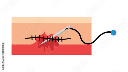 Medical Illustration of Surgical Sutures Closing a Wound Showing Needle Thread and Skin Layers in Red and Peach Tones with Blue Dot Accent