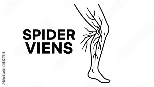 Black and white Line Art illustration showing the medical concept of Spider Veins or Telangiectasias