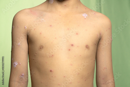 Photography portrait of a boy suffering from smallpox on the front of his body
