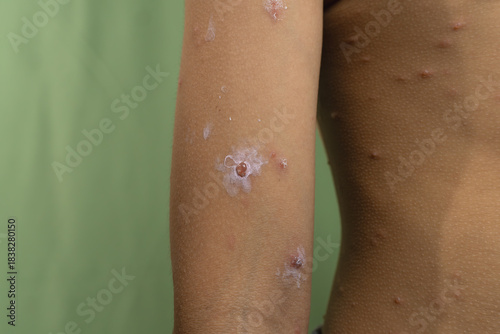 Quadro su tela close up of smallpox on a boy's arm.