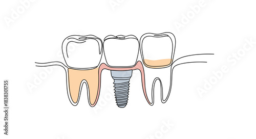 Continuous line drawing illustrating a dental bridge supported by a titanium dental implant replacing a missing tooth, flanked by natural teeth with gums.