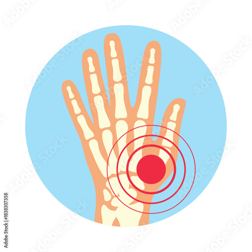 Visual representation of rheumatoid polyarthritis affecting hands with focus on pain in the joint area in a simple vector style