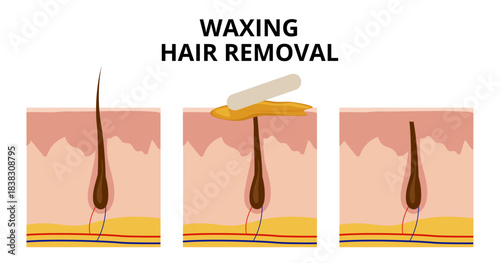 Waxing hair removal process showing before, during and after phases