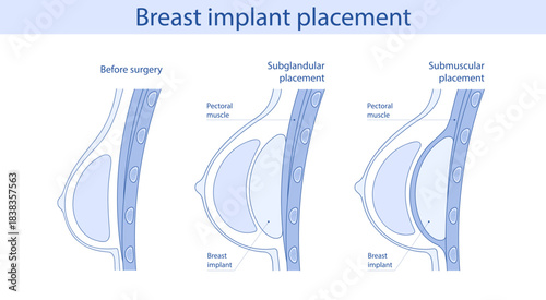 Breast implant placement diagram. Subglandular and submuscular types of placement. Medical illustration plastic surgery of breast implants.