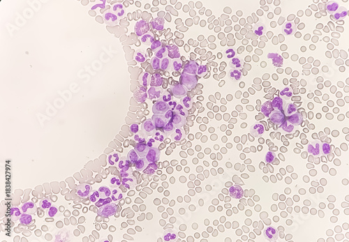 Chronic myeloid leukemia cells or CML, analyze by microscope
