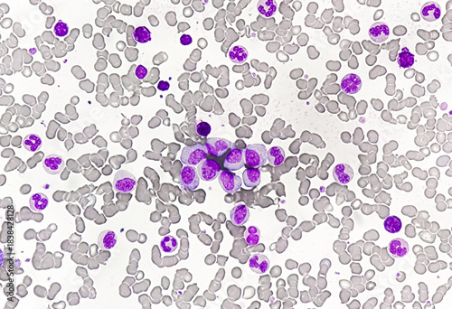 Chronic myeloid leukemia cells or CML, analyze by microscope