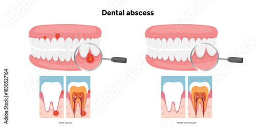 Hand-drawn dental infographic comparison between healthy teeth and teeth with dental abscess, including detailed anatomy of both