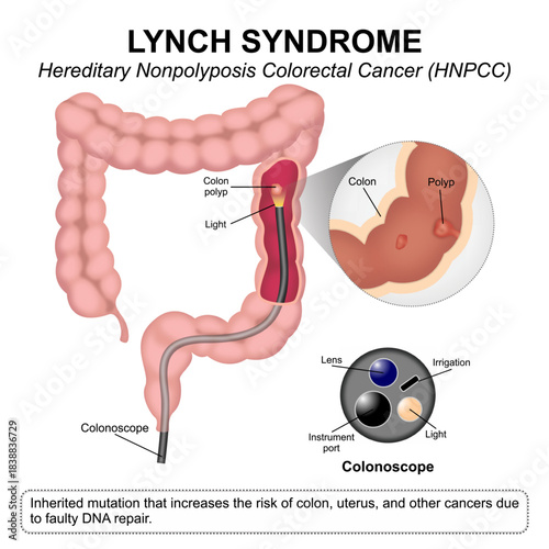 Lynch syndrome - Hereditary Nonpolyposis Colorectal Cancer