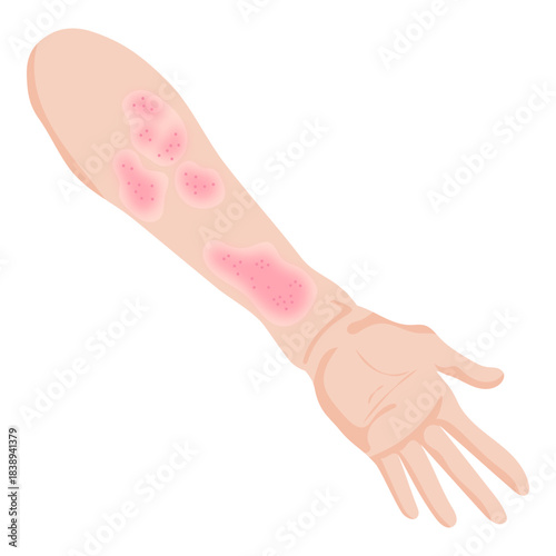 Arm With Rash Spots