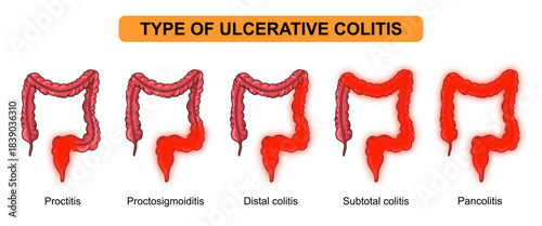 Illustration types of ulcerative colitis. Inflammation of the human digestive system. Inflammatory bowel disease, Inflammation of the human digestive system. Vector drawing illustration for medical