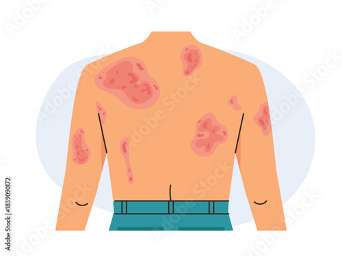 Man is allergic to itching, patients with skin diseases