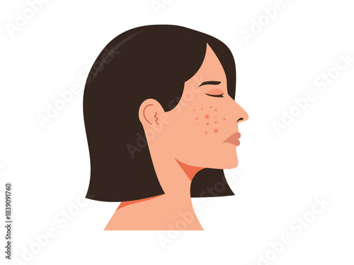 Woman face with acne, acne skin problems