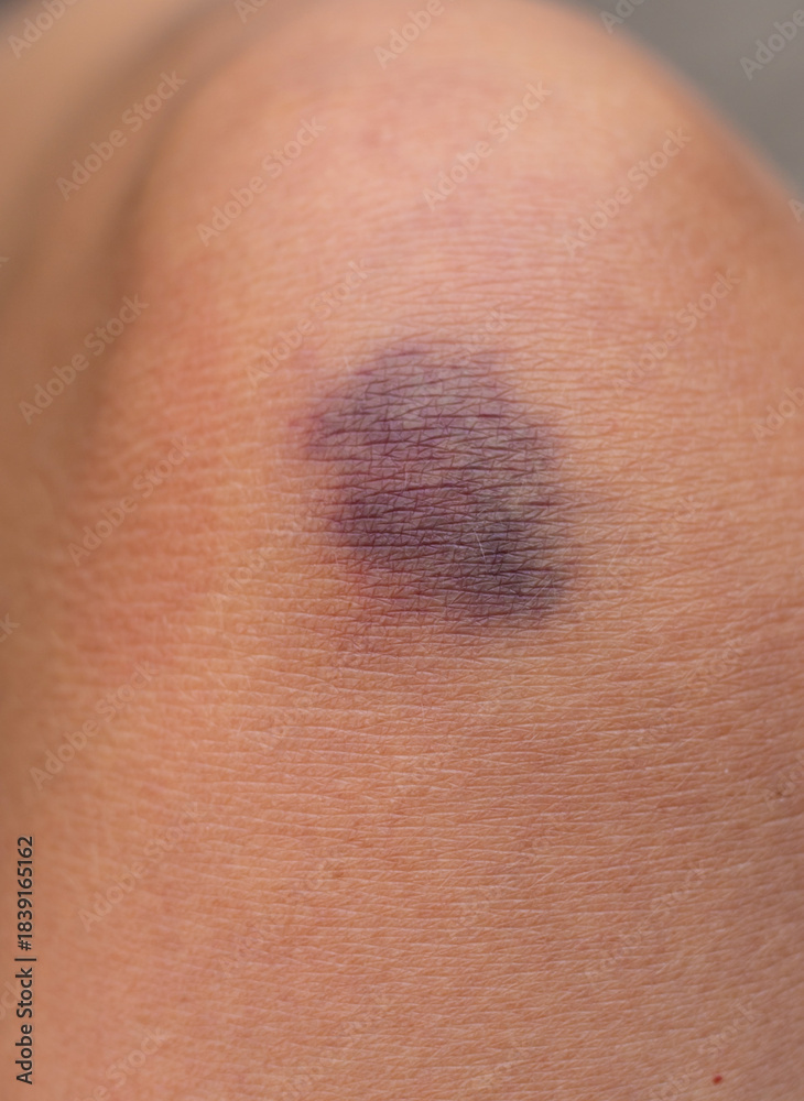 Fototapeta premium Bruise on a woman leg. Selective focus.