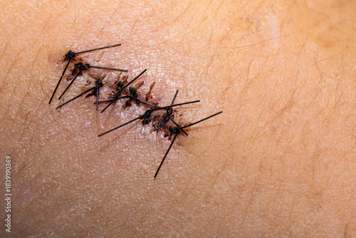 Konstfotografi Black surgical sutures before their removal from the wound