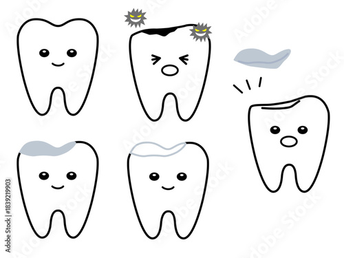 健康な歯、虫歯、治療した歯、詰め物が取れた歯のセット