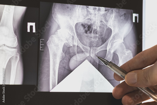 Doctor learn X-ray of dysplastic coxarthrosis of human legs.
