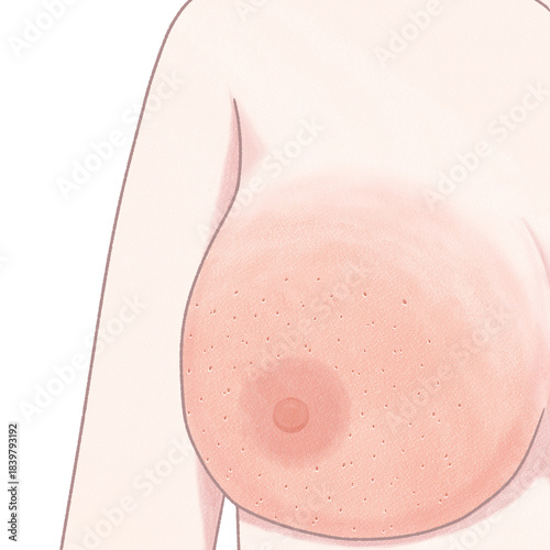 Blank Breast cancer symptoms Orange peel skin Medical diagram PNG