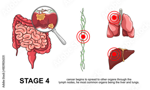 Illustration of colorectal cancer stages. Concept of colon cancer progression. Spread of tumor to lymph nodes. Medical vector illustration for clinics, education, and science.