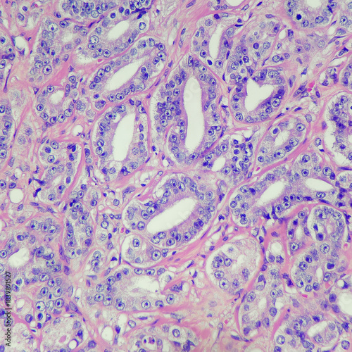 Camera photo of prostatic carcinoma, showing closely packed glands (Gleason pattern 3), magnification 400x, photograph through a microscope
