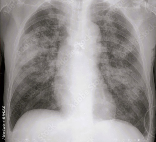 Chest x ray of  pneumonia radiology image, lung infection 	