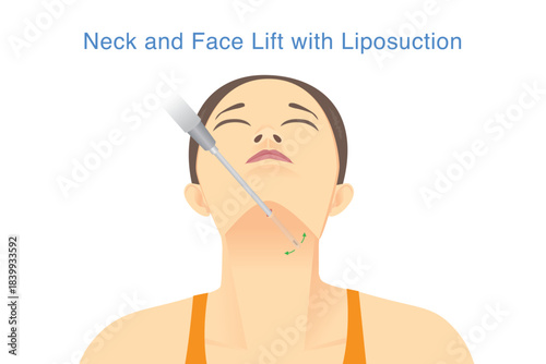 Neck and Face lift with Liposuction. woman lifts her head to allow the Cannula needle to be inserted under her chin for liposuction. Reducing excess body fat with medical technology.
