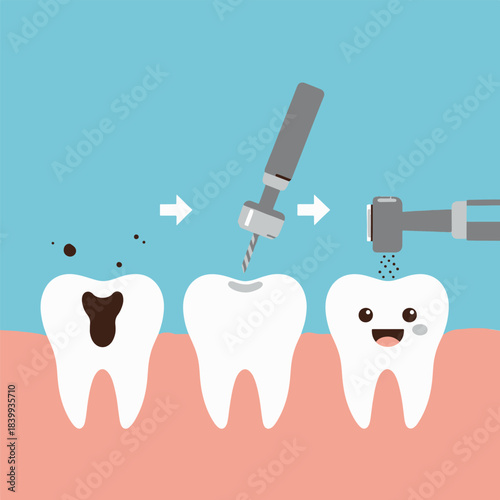 Illustrative Dental Procedure From Cavity Decay to a Healthy, Happy Tooth