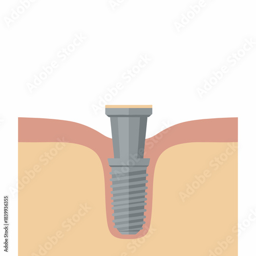 Detailed illustration of a single dental implant placement in human jawbone and gum tissue