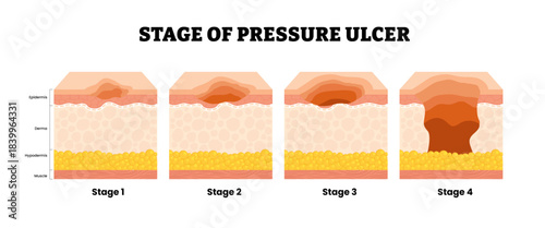 Stages of pressure ulcer stages first to fourth stage. Labeled skin structure epidermis, dermis, hypodermic, muscle. Bedsores pressure ulcer injury skin underlying tissue. Medical science illustration