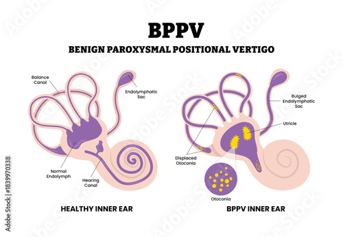 Benign Paroxysmal Positional Vertigo BPPV. Labeled displaced otoconia, utricle, bulged endolymphatic sac, hearing canal. Inner ear disorder. Flat vector. Medical science educational illustration