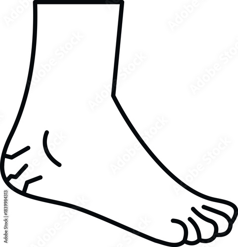 Human foot showing cracked heel and dry skin problem