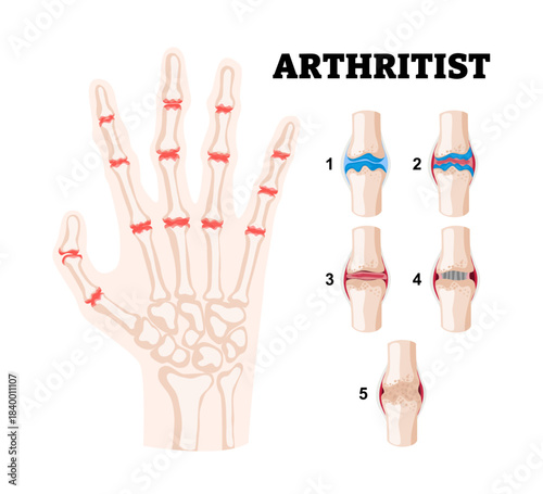 Stages of rheumatoid arthritis stages in fingers bone or human hand. deformation of the fingers and knuckles. Auto immune disease, inflammatory. Medical science educational illustration