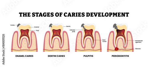 Stages of caries development stages. Labeled enamel, dentin caries, pulpitis, periodontitis. Infected pulp. Tooth structure anatomy with abscess, root canal. Periodontal ligament. Medical illustration