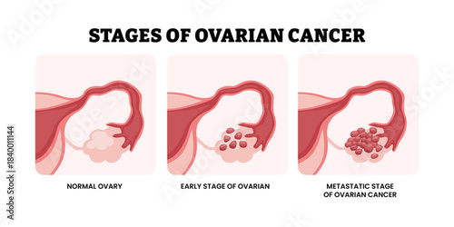 Stages of ovarian cancer stages. Labeled normal ovary, early stage, metastatic ovarian cancer. Gynecology and Obstetrics. Medical science educational illustration