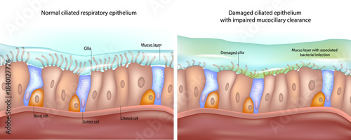 Medical illustration shows a comparison between normal ciliated respiratory epithelium and damaged epithelium with impaired mucociliary clearance. Healthy Versus Impaired Ciliated Epithelium 