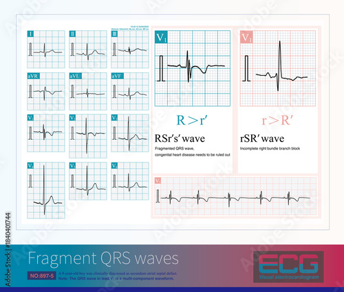 Sometimes, the QRS wave in lead V1 is a multi component waveform of rSRs, and should not be misdiagnosed as incomplete or complete RBBB. It is necessary to screen for congenital heart disease.
