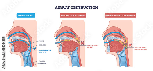 Airway obstruction diagram shows normal airflow vs blockage by tongue or foreign body, key parts, tongue, epiglottis, trachea, transparent background.