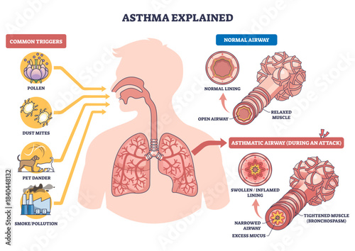 Asthma explained diagram shows lungs, bronchi, and triggers, contrast normal vs asthmatic airways showing inflammation, mucus, and tight muscles causing breathing trouble, transparent background.