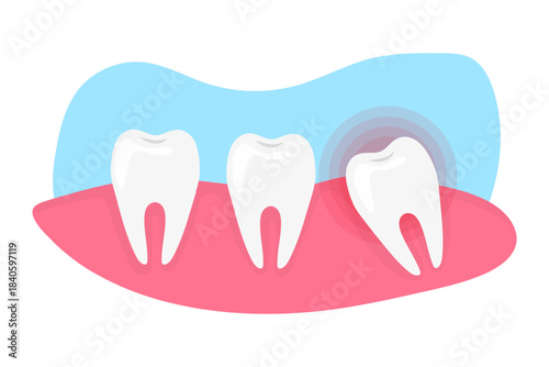 Wisdom Tooth pain and inflammation. Need of tooth extraction.