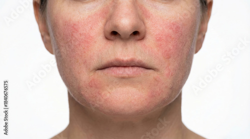 Woman with skin condition showing redness and irritation on face against white background